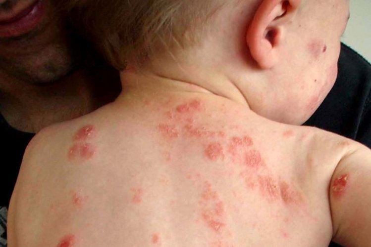 अगर शिशु को है एक्जिमा (eczema) तो - लक्षण और इलाज